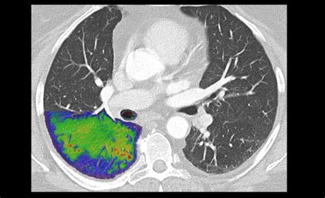 Photon Counting Detectors Lower Contrast Related Risks In Ct