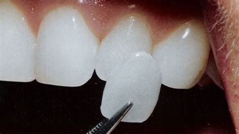 Lumineers Teeth vs Porcelain Veneers: Which Is Better?