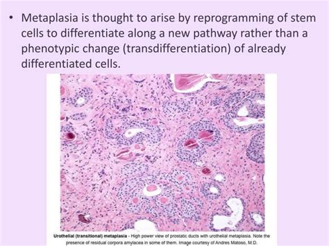 Metaplasia & Dysplasia