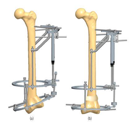 Correction Of Pediatric Femur Deformity Orthofix Abs