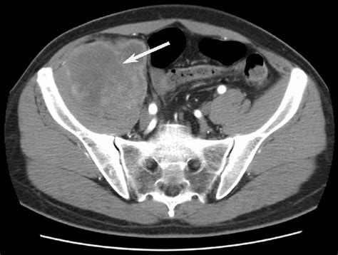 Pelvic Ct Scan