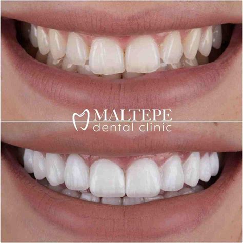 Veneers Vs Lumineers Welche Option Ist Besser Pro Kontra Maltepe