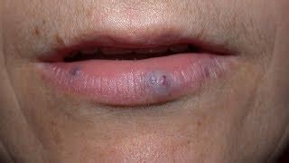 Melanoma Black Spots On Lips | Lipstutorial.org