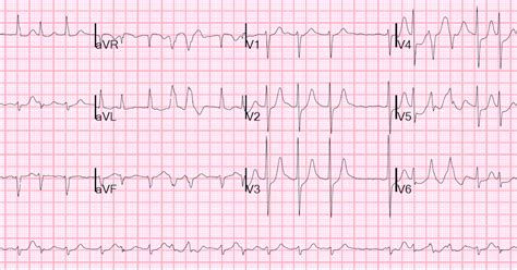 Dr. Smith's ECG Blog: Atrial fibrillation with RVR: use POCUS to assess ...