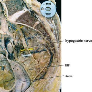 Sagittal View Of The Pelvis The Anterior Half Of The IHP Is Masked By