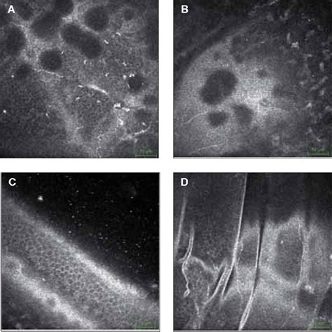 Epithelial Basement Membrane Dystrophy