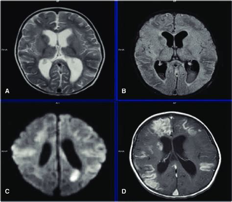 Hydrocephalus Mri