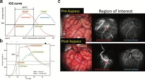 Imaging Methods For Surgical Revascularization In Patients With