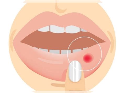 Mouth Ulcers Types Causes Symptoms And Treatment REPC