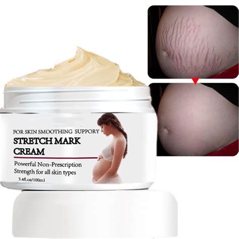 Amazon.com : Stretch Mark Prevention Cream for Pregnancy, Stretch Mark