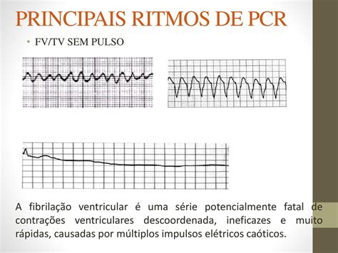 RCP Reanimação Cardio Pulmonar ppt carregar