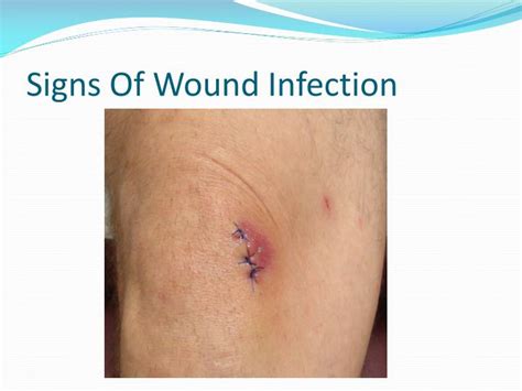 wound infection signs