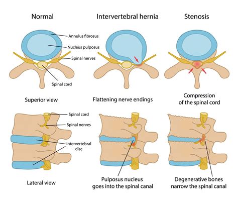 Neurochirurgische Wirbelsäulenerkrankungen MedUni Vienna