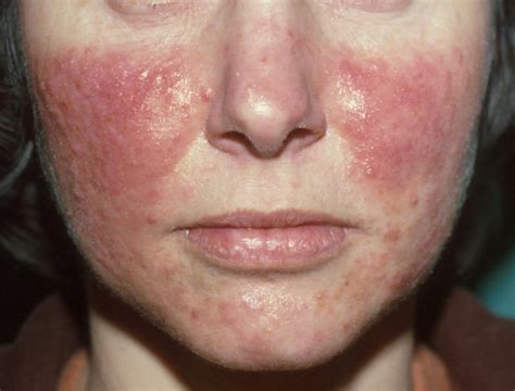 Rosacea Alcohol Pictures Photos