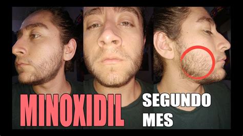 Minoxidil Para La Barba Segundo Mes Youtube