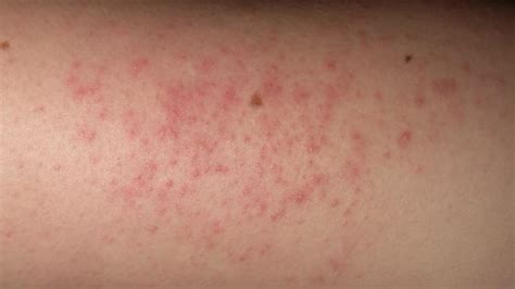 Causes Of Red Bumps On Legs