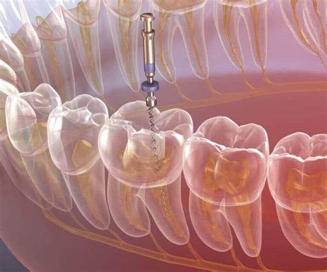 Leczenie Kana Owe Pod Mikroskopem Endodoncja Mikroskop