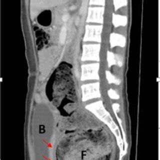 CT Scan Sagittal View Of The Abdomen And Pelvis Showing Megarectum