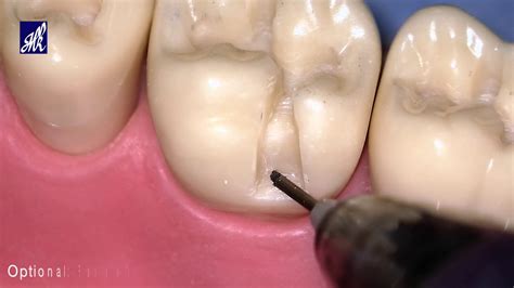 Class I Cavity Preparation For Composite Mandibular Molar Off