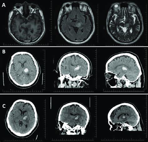 A Preoperative Axial T1 Weighted Precontrast Left T2 FLAIR