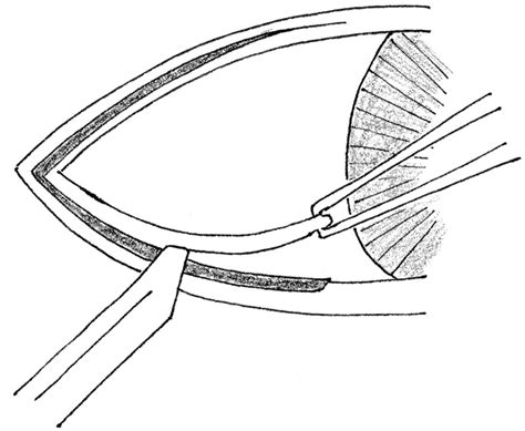 Community Eye Health Journal » Performing a tarsorrhaphy