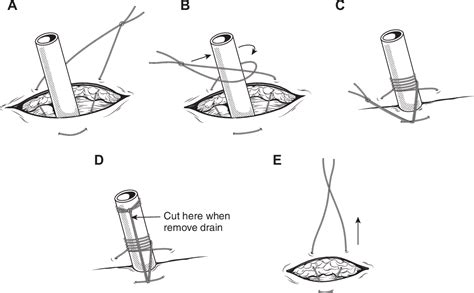 Figure From Thoracic Trauma Which Chest Tube When And Where