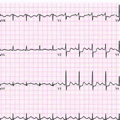 Ekg Showing St Elevation In Leads Ii Iii And Avf With St Depression In Download Scientific