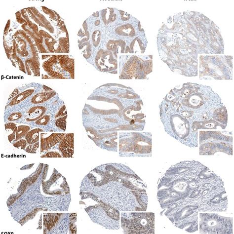 Weak Staining Of β Catenin Predicts Poor Outcome Download Scientific