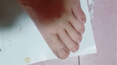 쿨니스 내성발톱제거 시술 Asmr Coolness Ingrown Toenail Removal Treatment Part 343