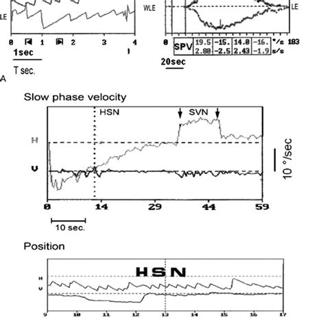 A And B Caloric Test And Svint At 100 Hz In A Patient With Left Mé Niè Download Scientific