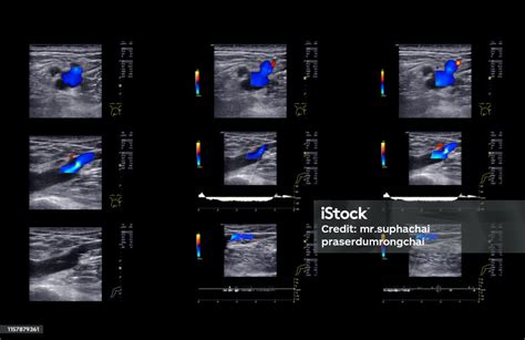 下肢の深部静脈血栓症を見つけるための超音波ドップラー 超音波検査のストックフォトや画像を多数ご用意 超音波検査 静脈 動物の動脈