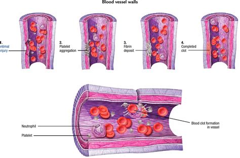 Disseminated Intravascular Coagulation Clotting Cascade