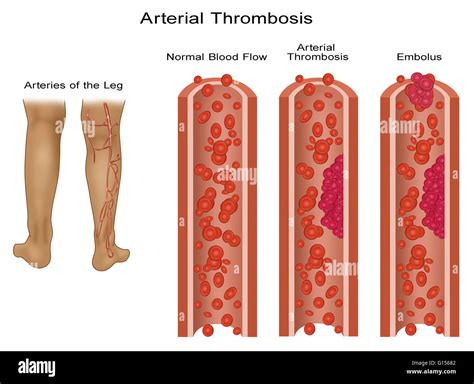 Symptoms Of A Blood Clot In Lower Leg Symptoms In Legs Lungs And More