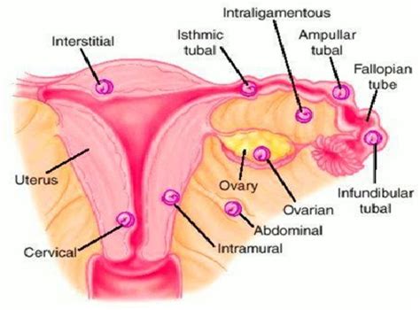 All About Fibroids And Their Management By Dr Deepti Asthana The Best