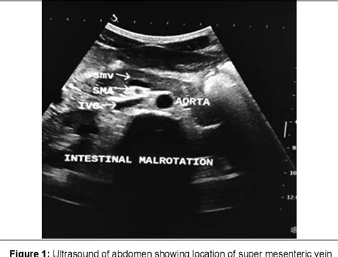 Partial Malrotation Of Bowel Loops In An Adolescent With Left Hypochondrial Pain Semantic Scholar