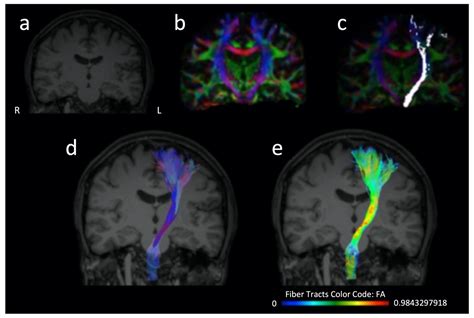 Diffusion Tensor Imaging In Prognostic Of Acute Hyperacute Stroke