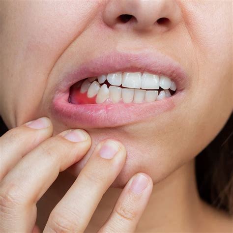 Mira Clinic Gum Infection Symptoms Causes Treatment And Prevention