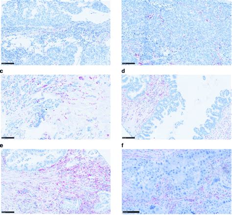 Rna Chromogenic In Situ Hybridization Cish For Cirs 7 In Various