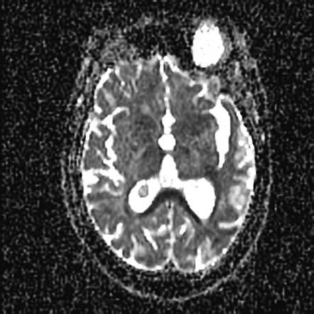 Choroid Plexus Xanthogranuloma Image Radiopaedia Org