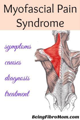 Myofascial Pain Syndrome