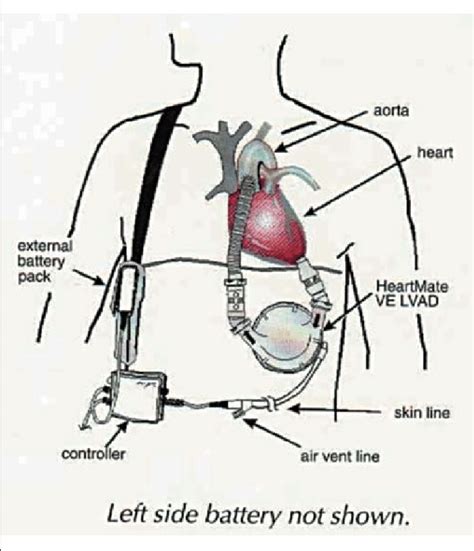 Schematic Diagram Of The Heartmate Xve Left Ventricular Assist Device