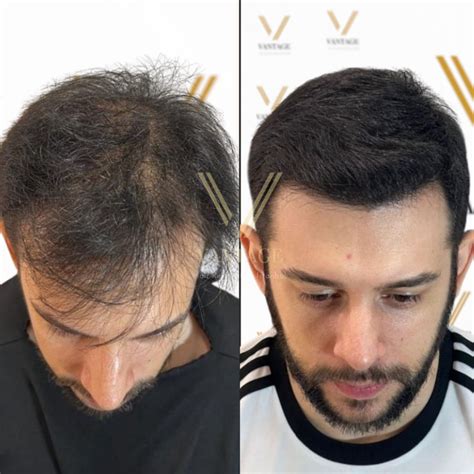 Fue Hair Transplant In Turkey Costs In 2024 Vantage