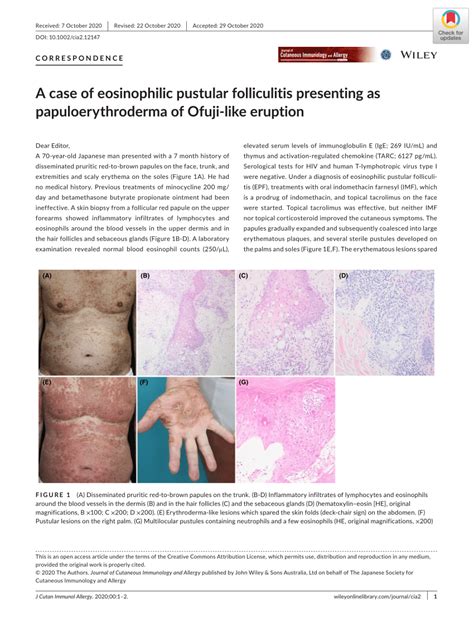 Pdf A Case Of Eosinophilic Pustular Folliculitis Presenting As