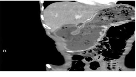 Figure From Primary Pyloroduodenal Tuberculosis Presenting As Gastric