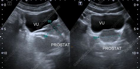 Normal Prostate Ultrasound Scan Stock Image F042 7368 Science