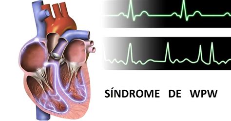 ¿taquicardias Frecuentes Conoce El Síndrome De Wolff Parkinson White