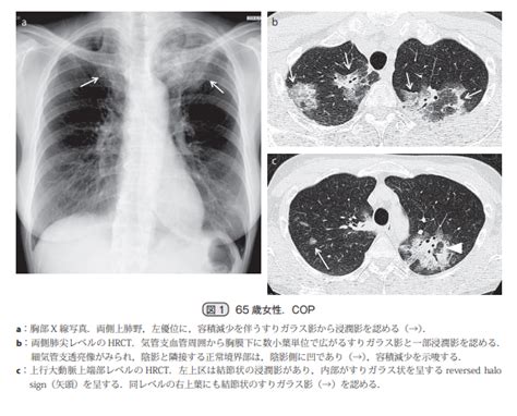 器質化肺炎について│不識庵 万年研修医のブログ