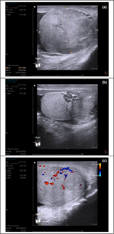 Rare Paratesticular Aggressive Angiomyxoma Mimicking An Epididymal