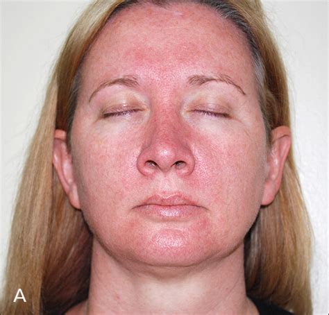 Rosacea Symptoms And Treatments Mama Nature