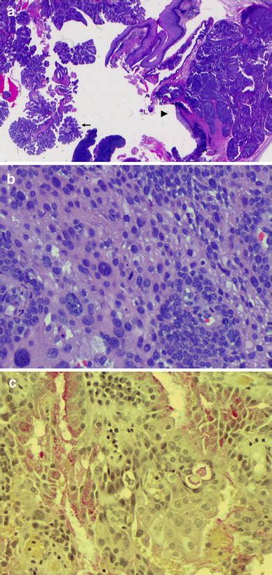 Afip Grading Of Mucoepidermoid Carcinoma A Collection Of Surgical Pathology